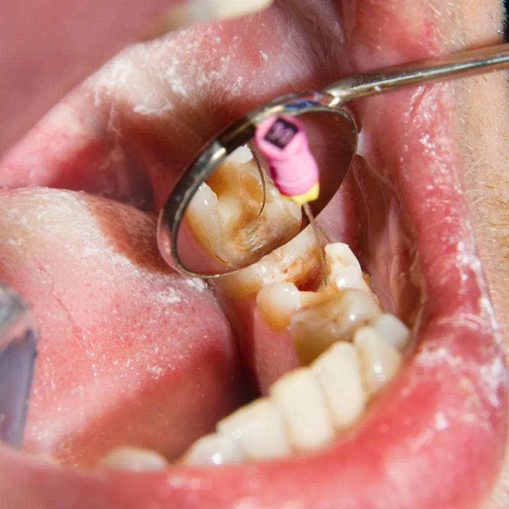 QualCert Level 6 Diploma in Endodontics (Dip Endodontics) 5 QualCert Level 6 Diploma in Endodontics