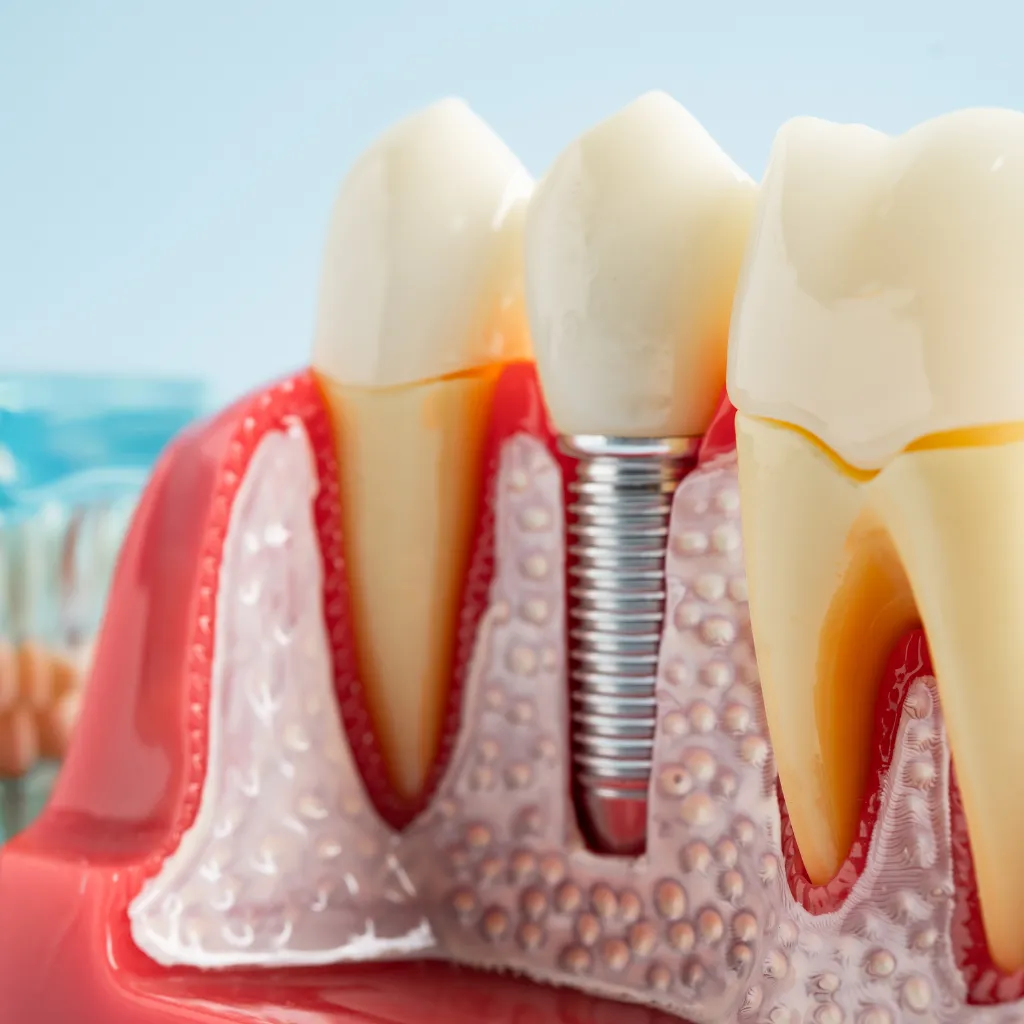 QualCert Level 6 Diploma in Implant Dentistry