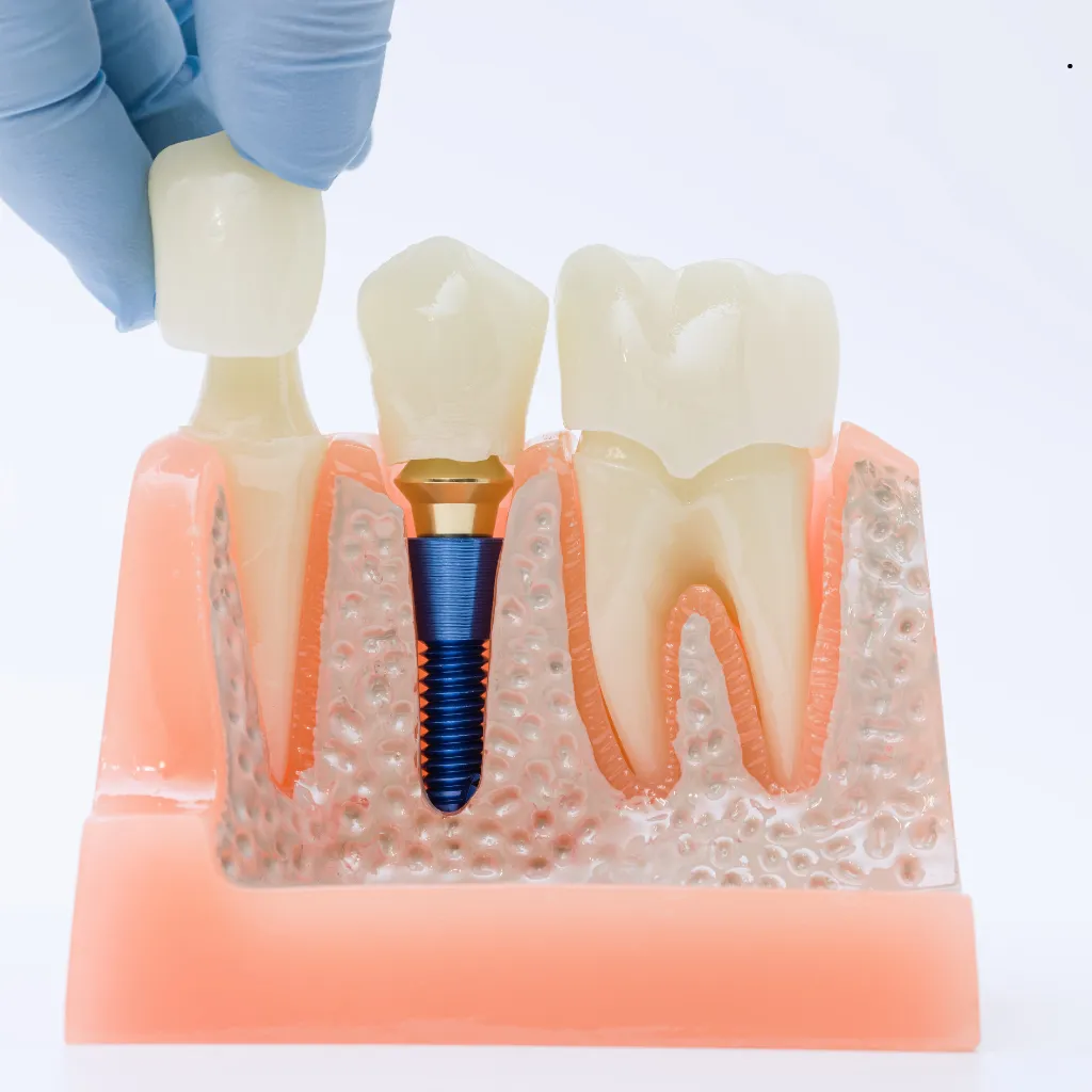 QualCert Level 7 Postgraduate Diploma in Implant Dentistry 